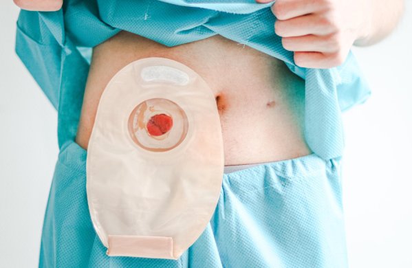 Tratamiento de Estomas en CDMX y Naucalpan